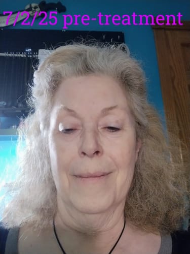 Customer photo review of 3 Month Supply - Seranova Micro Infusion System