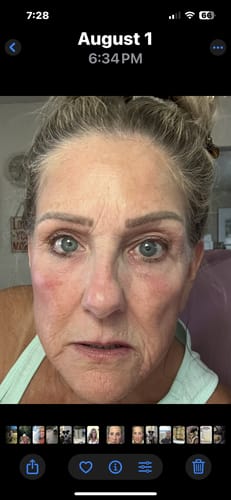 Customer photo review of 3 Month Supply - Seranova Micro Infusion System