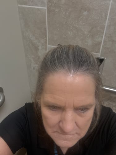 Customer photo review of 3 Month Supply - Seranova Micro Infusion System