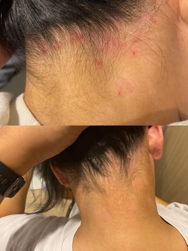 Customer photo review of Eczema Scratch Mitten