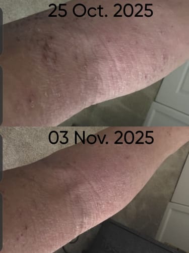 Customer photo review of Eczema Scratch Mitten