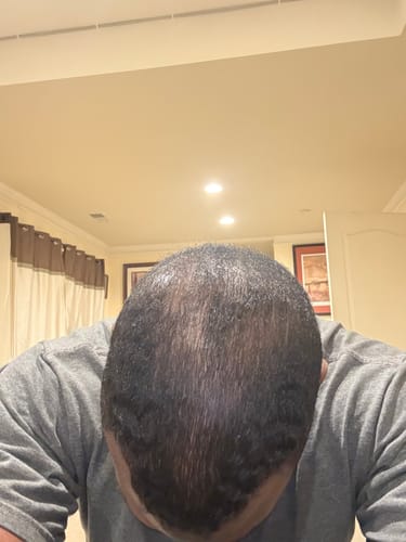 Customer photo review of Rennora Hair Growth Serum