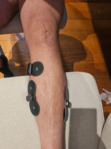 Customer photo review of Vibit TENS - Electrical Nerve Stimulation Therapy