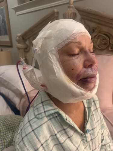 Customer with facial bandages and significant bruising around the mouth and nose after surgery, before using Arnica Gel.