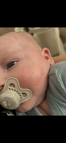 Customer's close-up of a baby's face with red, bumpy skin before using Calm Balm.