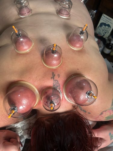 Customer photo review of Premium Cupping Cups - Mixed Sizes from B1 to B6