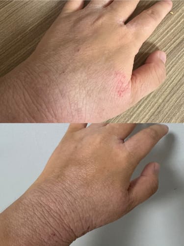 Customer photo review of Eczema Scratch Mitten