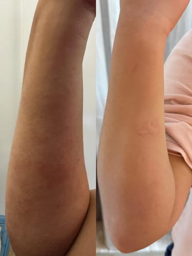 Customer photo review of Eczema Scratch Mitten