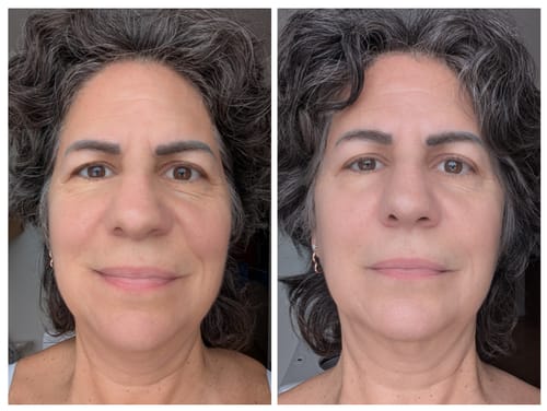 Customer photo review of JOVS 4D Laser Light Therapy Mask