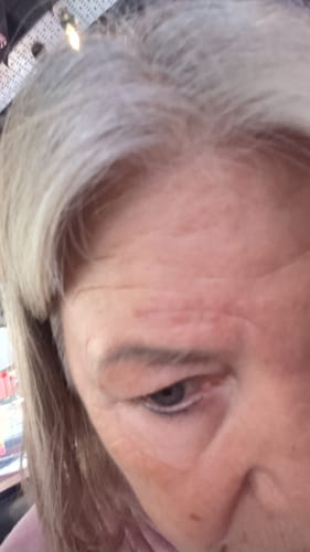 Reviewer's close-up of their forehead, showing a healing facial scar after using the Calm Skin-Relief Kit.