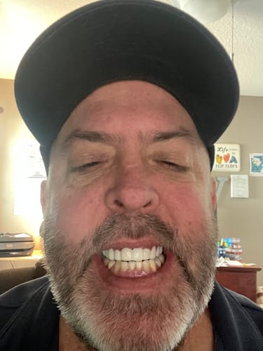 Reviewer smiling to show his natural-looking upper Pop On Veneers.