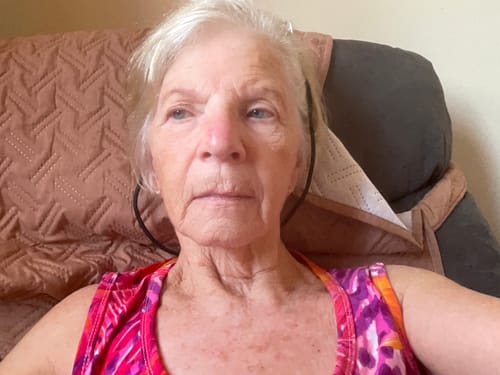 Customer's portrait showing their facial skin after using the Seranova Micro Infusion System.