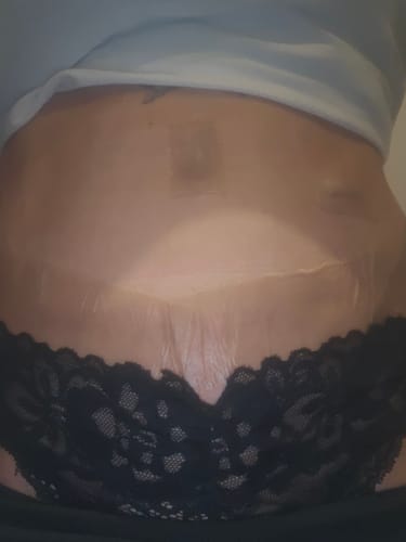 Customer photo review of ScarRelief™ | Silikon-Narbenpflaster