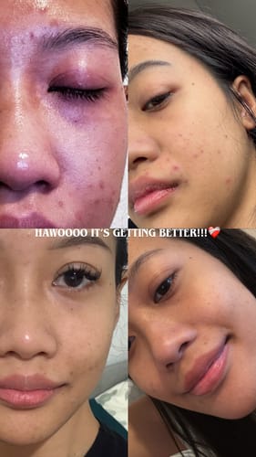 Customer photo review of Skin Clearing Honey & Turmeric Bar