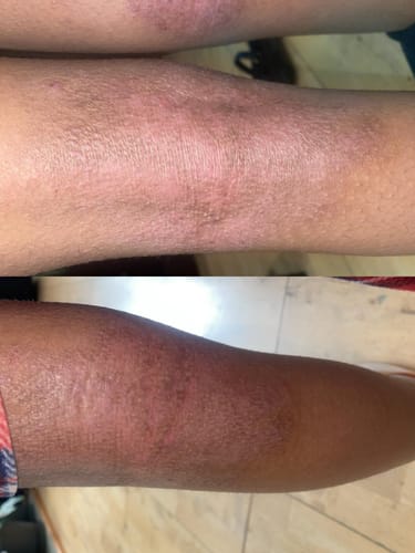 Customer photo review of Eczema Scratch Mitten