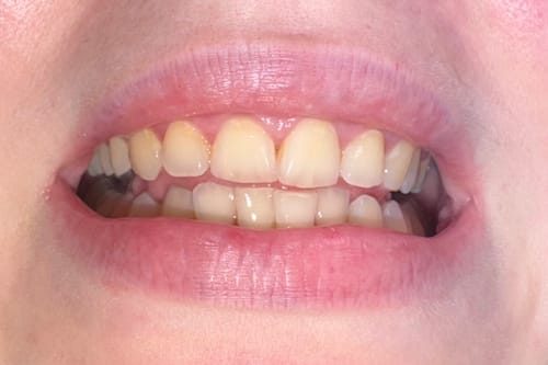 Customer photo review of Advanced Teeth Whitening Kit
