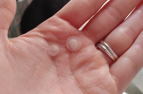 Customer photo review of Acne Patches