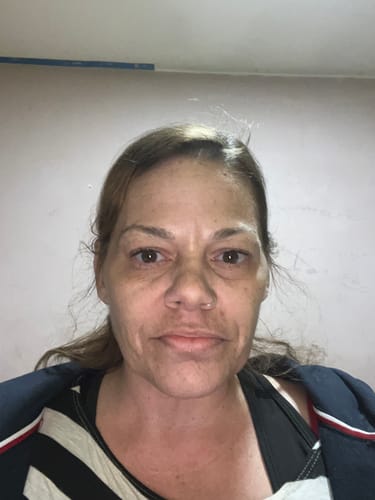 Customer photo review of NoseFix: Botox