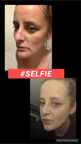 Customer photo review of ReGlow Micro Infusion System