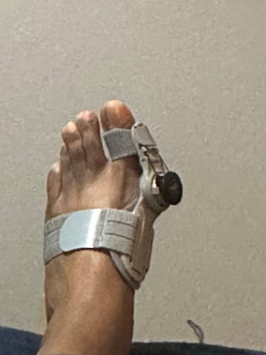 Customer photo review of Treatmedy™ Bunion Fix - Natural At-Home Bunion Relief