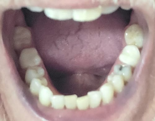 Customer photo review of Flexible Partial Denture, Includes 1 tooth, Save $52 **** Use Code:TCG15 at checkout