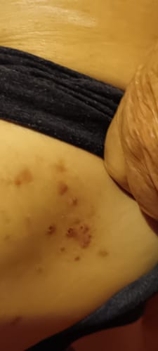 Customer photo review of SERENI Pikkelysömör és Ekcéma Krém