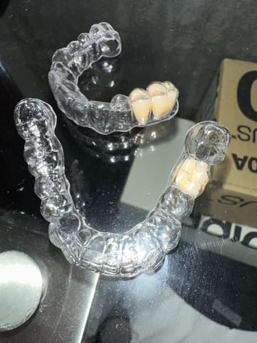 Customer photo review of Essix Clear Retainer, Includes 1 Tooth