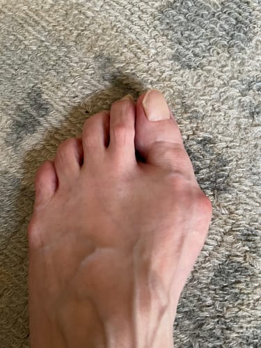 Customer photo review of Treatmedy™ Bunion Fix - Natural At-Home Bunion Relief