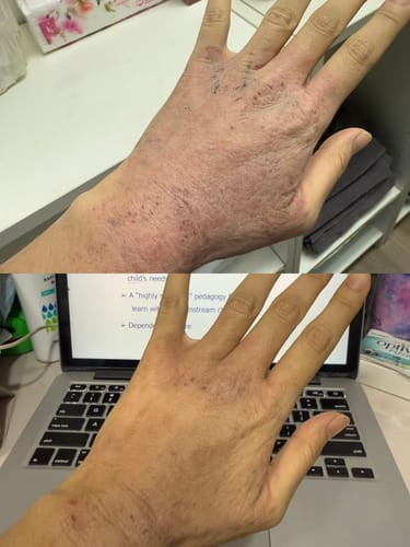 Customer photo review of Eczema Scratch Mitten