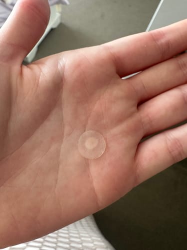 Customer photo review of Pimple Pals - Pimple Patches