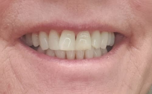 Customer photo review of Prostrips Teeth Whitening Strips