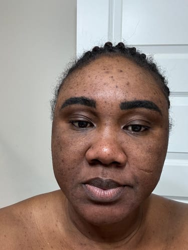 Customer photo review of 24k Golden Glow Essential Acne Kit