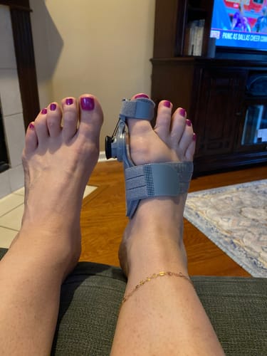 Customer photo review of Treatmedy™ Bunion Fix - Natural At-Home Bunion Relief