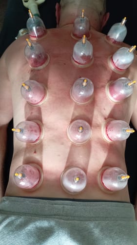 Customer photo review of Standard Cupping Cups - Mixed Sizes from B1 to B6