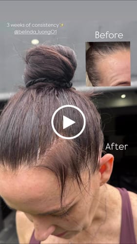 Customer video review of Derma Roller