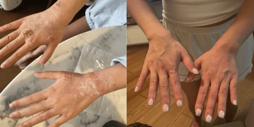 Customer photo review of Eczema Scratch Mitten
