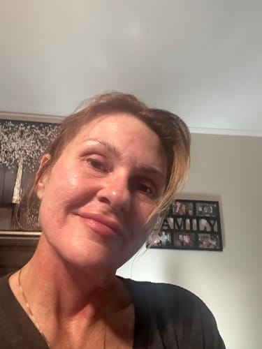 Customer photo review of The Microneedling Infusion System™