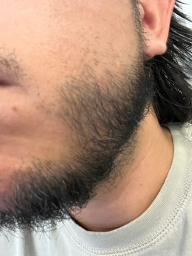 Customer photo review of Oral Minoxidil 10mg tablets For Hair Loss