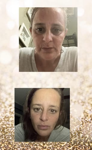 Customer photo review of ReGlow Micro Infusion System