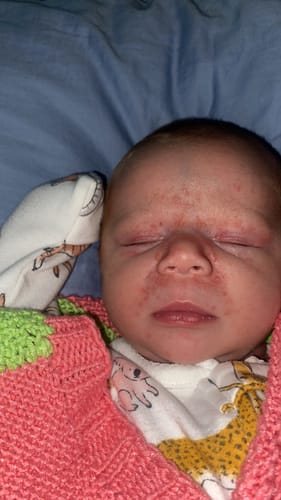 Customer photo review of All Over Ointment Eczema Treatment