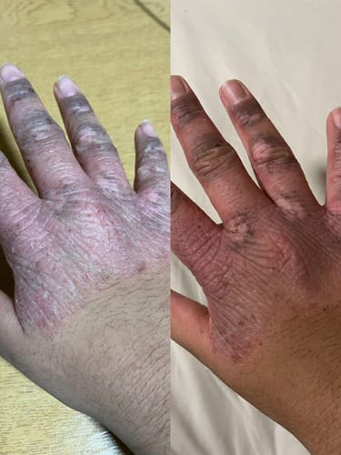 Customer photo review of Eczema Scratch Mitten