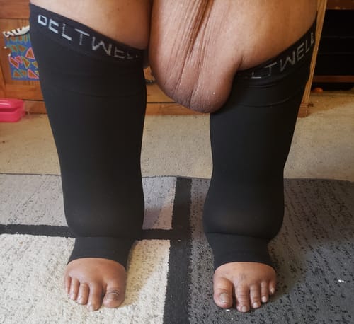 Customer photo review of Beltwell® - Toeless Compression Socks (2 pairs)