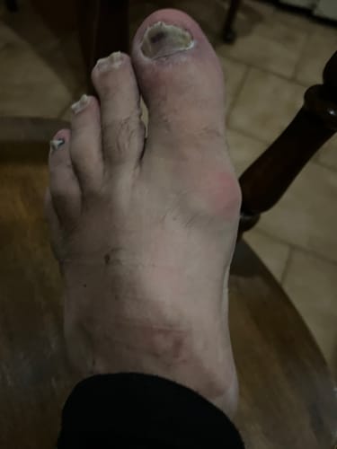 Customer photo review of Treatmedy™ Bunion Fix - Natural At-Home Bunion Relief