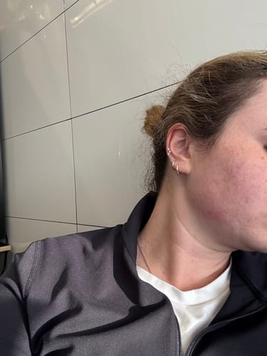 Customer photo review of Advanced Acne Program™