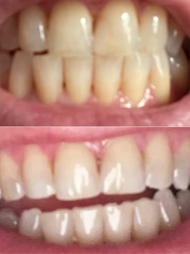 Customer photo review of Teeth Whitening Strips