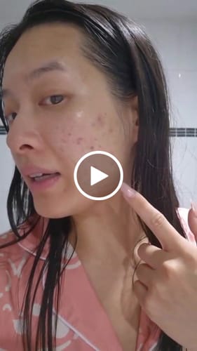 Customer video review of Starter Acne Program™