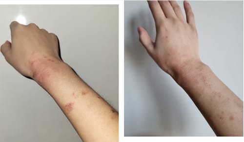 Customer photo review of Eczema Scratch Mitten