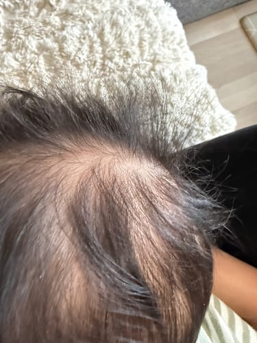 Customer photo review of Bye-Bye Cradle Cap