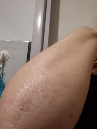 Customer photo review of Sereni Pikkelysömör és Ekcéma Krém