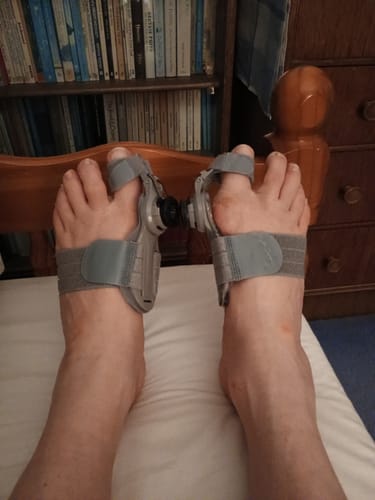 Customer photo review of Treatmedy™ Bunion Fix - Natural At-Home Bunion Relief